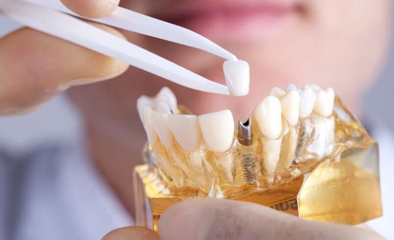 Dental Aligners in Pune | Personalized Teeth Straightening Care