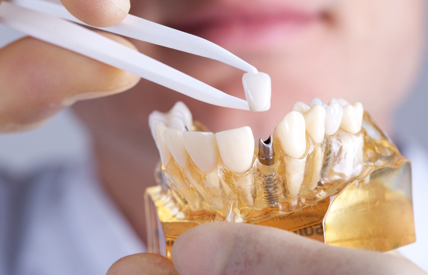 Dental Aligners in Pune | Personalized Teeth Straightening Care