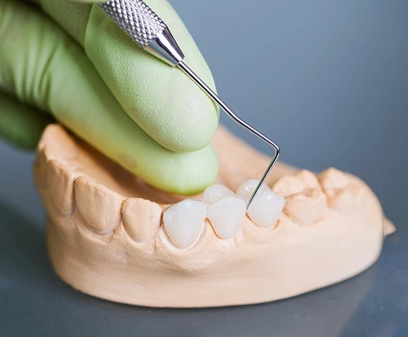 How Can Affordable dental implants Santa Ana Patients Find Quality Care Without Sacrificing Long Term Value